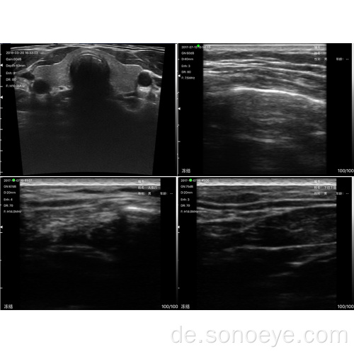 Superweiten linearer Ultraschallscanner für Brustinspektion